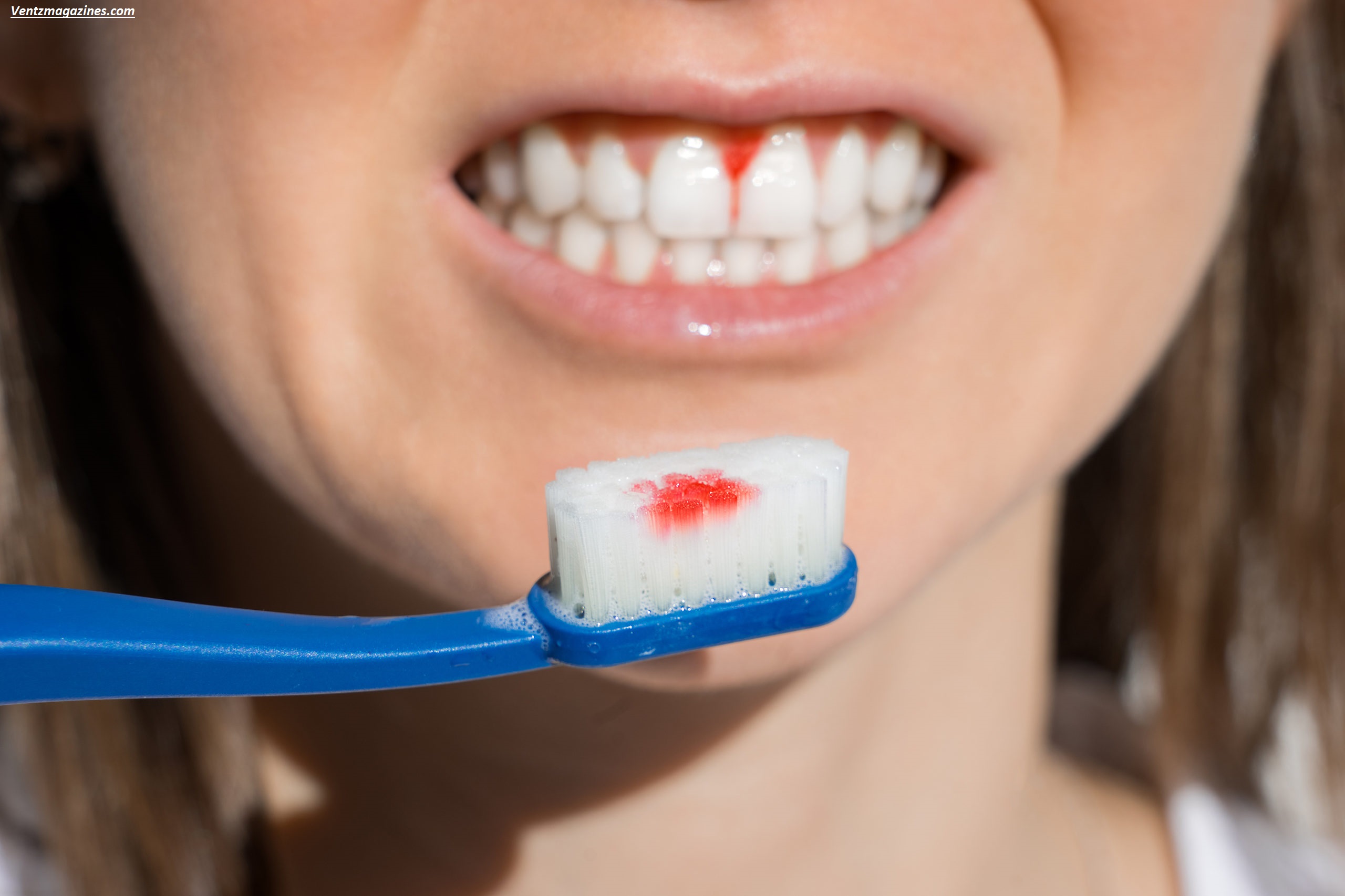 Why Are My Gums Bleeding? 7 Shocking Reasons You Shouldn’t Ignore