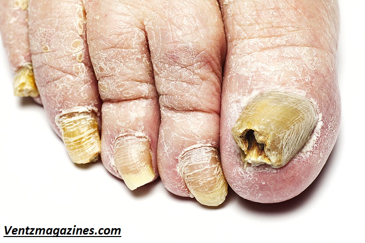 Why Are My Toenails Yellow? Causes & Quick Fixes