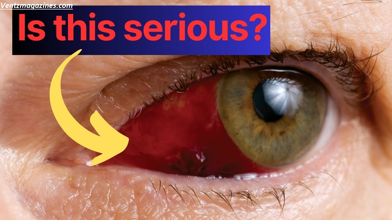 Why Is My Eye Red? Doctors Explain the Most Common Causes