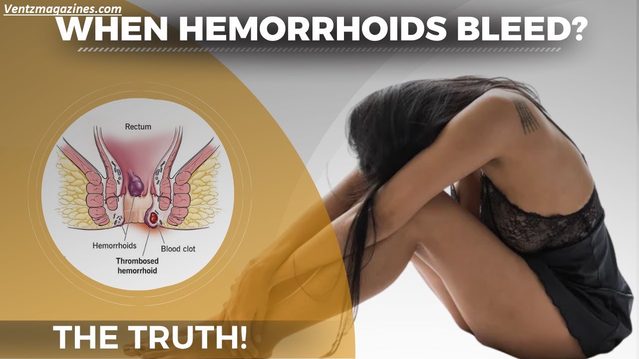 Why Do Hemorrhoids Bleed? 7 Causes Doctors Reveal