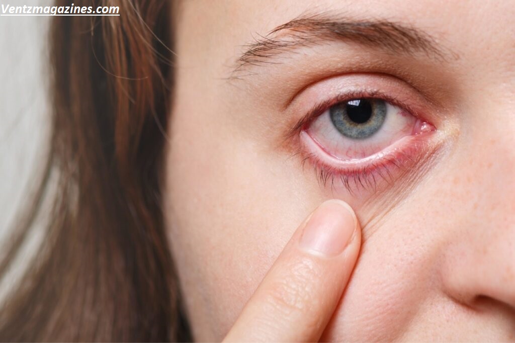 Why Is My Eye Red? Causes, Symptoms & Treatment Guide